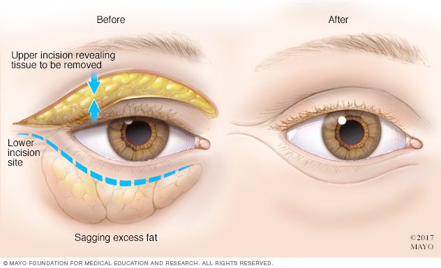 bags-under-eyes-disease-reference-guide-drugs